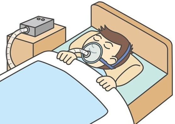 CPAP